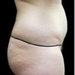Female Liposuction Before & After Patient #948