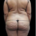 Female Liposuction Before & After Patient #960