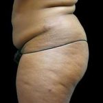 Female Liposuction Before & After Patient #995