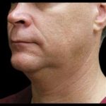 Male Liposuction Before & After Patient #1032