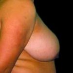 Liposuction and Breast Reduction Before & After Patient #672