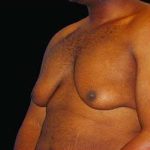 Male Liposuction Before & After Patient #1071