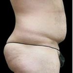 Male Liposuction Before & After Patient #1080