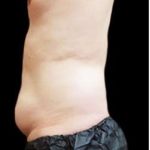 Male Liposuction Before & After Patient #1089
