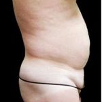 Male Liposuction Before & After Patient #1099