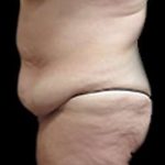 Liposuction and Mommy Makeover Before & After Patient #1112