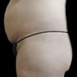 Liposuction and Mommy Makeover Before & After Patient #1133