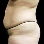 Liposuction and Mommy Makeover Before & After Patient #1150