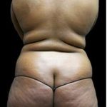 Liposuction and Mommy Makeover Before & After Patient #1157