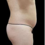 Liposuction and Mommy Makeover Before & After Patient #1166