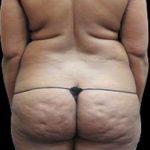 Liposuction and Mommy Makeover Before & After Patient #1177