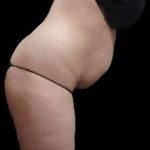 Liposuction and Mommy Makeover Before & After Patient #1186