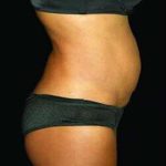 Liposuction and Mommy Makeover Before & After Patient #1193