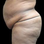 Liposuction and Mommy Makeover Before & After Patient #1231