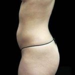Liposuction and Mommy Makeover Before & After Patient #1247