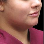 Laser Neck Lift and Submental Liposuction Before & After Patient #1258