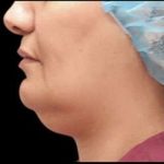 Laser Neck Lift and Submental Liposuction Before & After Patient #1279