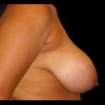 Liposuction and Breast Reduction Before & After Patient #694