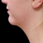 Laser Neck Lift and Submental Liposuction Before & After Patient #1286