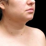 Laser Neck Lift and Submental Liposuction Before & After Patient #1297