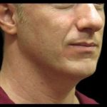 Laser Neck Lift and Submental Liposuction Before & After Patient #1304