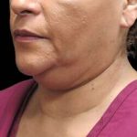 Laser Neck Lift and Submental Liposuction Before & After Patient #1315