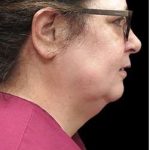 Laser Neck Lift and Submental Liposuction Before & After Patient #1328
