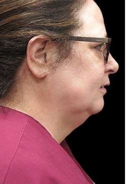 Laser Neck Lift and Submental Liposuction Before & After Patient #1328