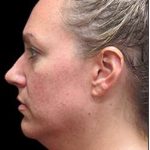 Laser Neck Lift and Submental Liposuction Before & After Patient #1335