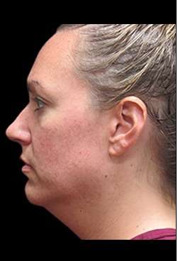 Laser Neck Lift and Submental Liposuction Before & After Patient #1335