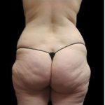 Super Wet Liposuction Before & After Patient #1353