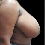Liposuction and Breast Reduction Before & After Patient #705