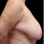 Liposuction and Breast Reduction Before & After Patient #712