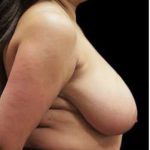 Liposuction and Breast Reduction Before & After Patient #719