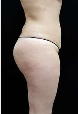 Female Liposuction Before & After Patient #834
