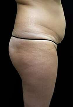 Female Liposuction Before & After Patient #834